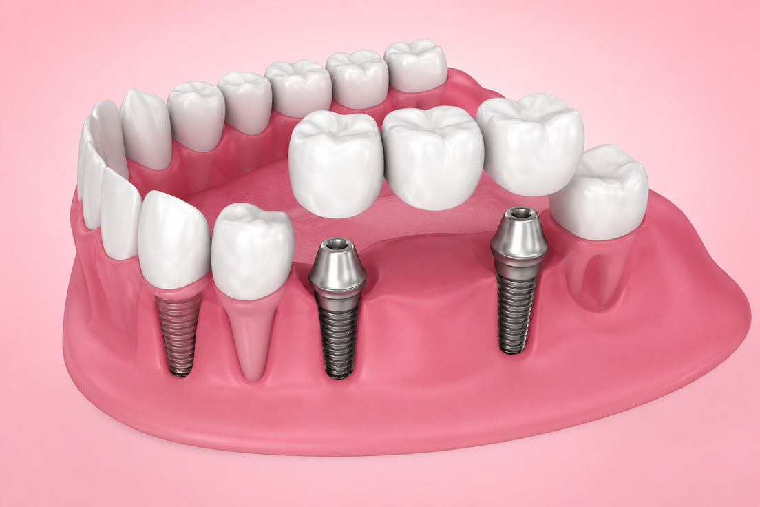 Esempio di ponte dentale su modello