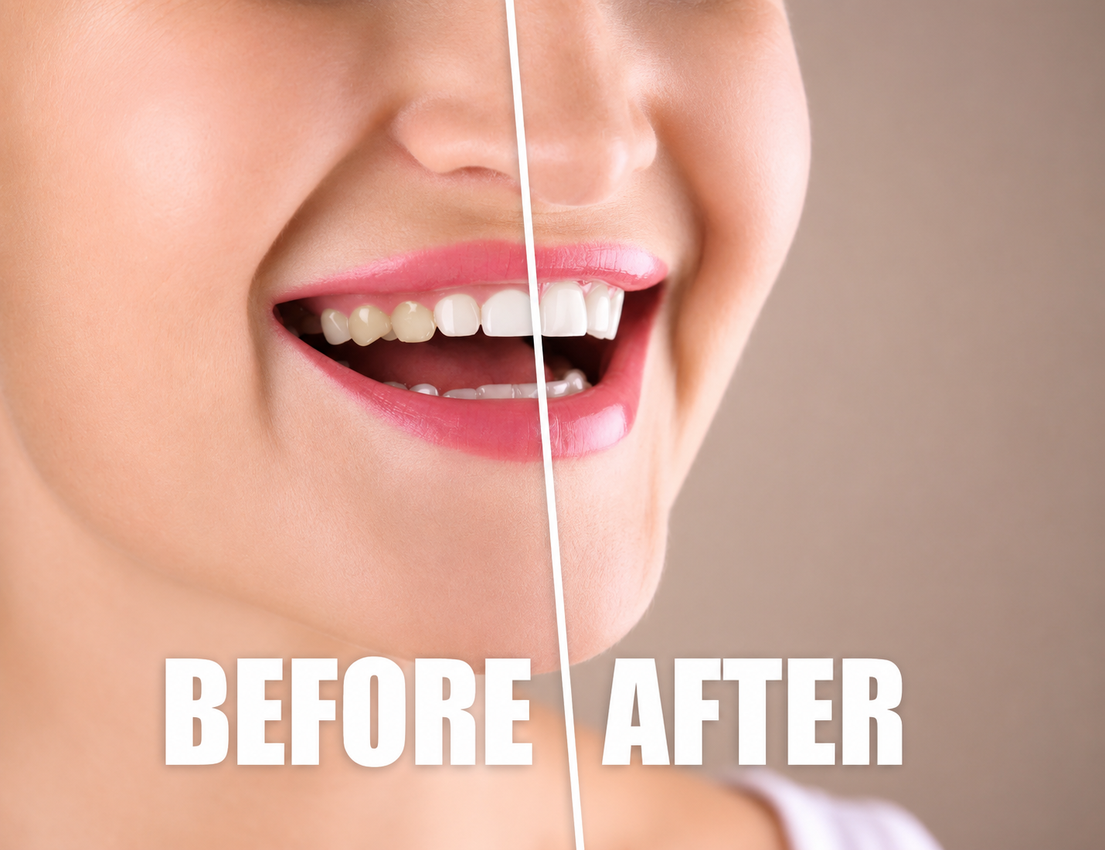 Contouring gengivale per armonizzare il sorriso