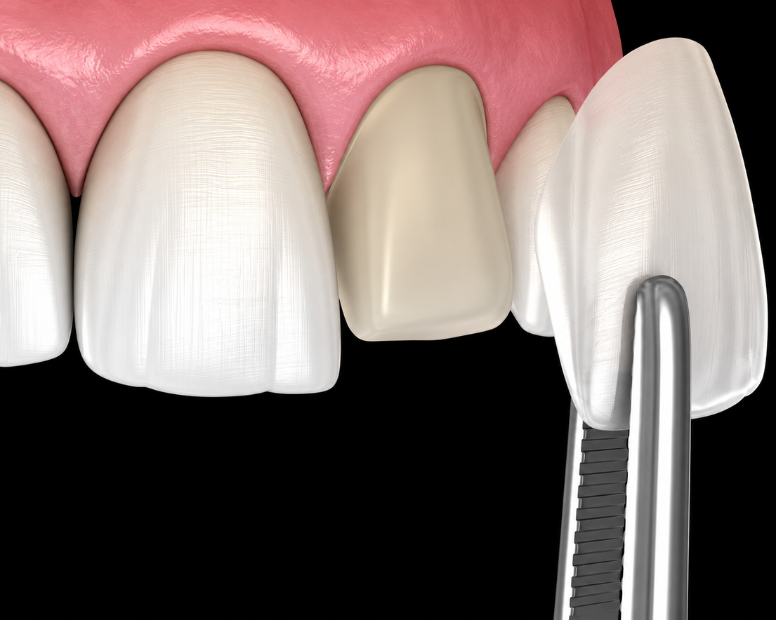 Dettaglio di faccette dentali su incisivi
