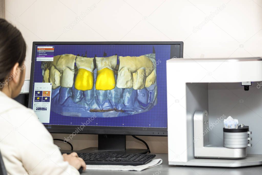 Corone dentali su modello
