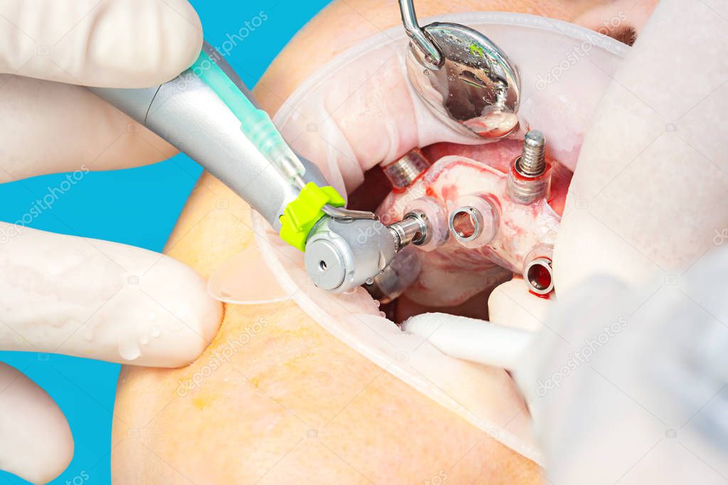 Guida chirurgica per implantologia